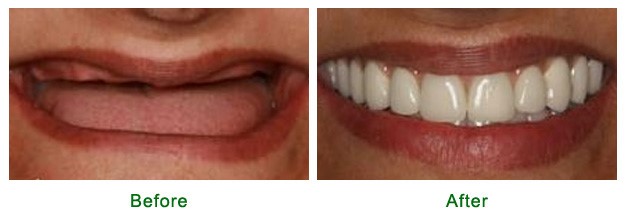 Occlusion In Complete Dentures Oklahoma City OK 73194